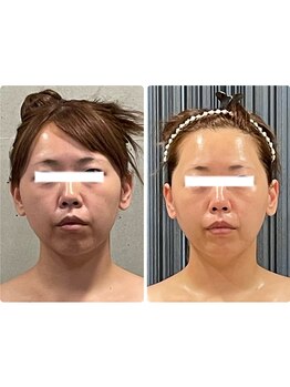 エクセレントビューティーサロン 艶(EN)/VENUSソニック アクアピーリング