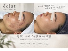 エクラ(eclat)