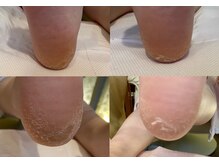 ビサンテ サロン/乾燥ガサガサ踵・足裏に角質ケア