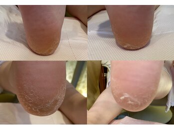 乾燥ガサガサ踵・足裏に角質ケア
