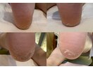 乾燥ガサガサ踵・足裏に角質ケア