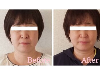 小顔矯正サロン ブルーム/施術3回ビフォーアフター