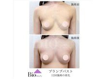 バイオビューティー 神戸本店(Bio Beauty)/プランプバスト　12回コース症例