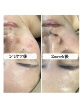 ル ボヌール/シミケア　垢化2回