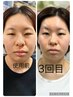 潤い肌へ【究極のエンジングケア】エンダモロジー　80分　￥22,000→￥9、800