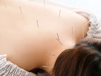 高麗鍼灸院の写真/【ガチガチに固まった身体に、鍼とカッピングで速攻リリース】国家資格保有者による技術で不調を解決♪