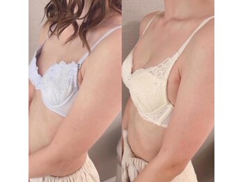 スマイルクルー(SmileClue)/6回の施術と食事改善での変化