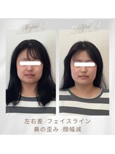 りもあず(ReMore-S)/小顔矯正3回/食いしばり/顎ガク