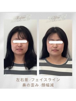 りもあず(ReMore-S)/小顔矯正3回/食いしばり/顎ガク