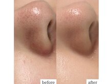 ルポ(RUPO)/毛穴の黒ずみ・詰まり・ざらつき