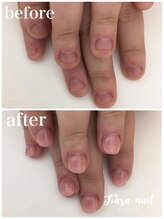 ティアラネイル 宇都宮/リプロネイル深爪矯正コース