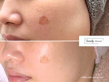 ビューティー ブロッサム(Beauty Blossom)/