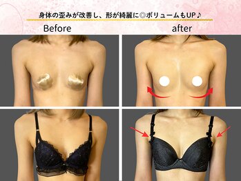 ロットプラス(Lot Plus)/バストアップ症例【C→Dカップ】