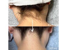 エルム 京都駅前店(elm)/＊うなじ脱毛＊