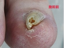 レフス 北参道店(REFUSS)/巻き爪矯正