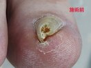 巻き爪矯正