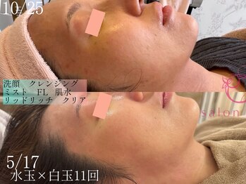 サロンヴェアリー 広尾(salon vary)/水玉リフティング+白玉