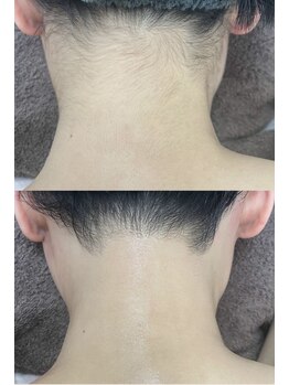 カルディエ(Cardie)/うなじ脱毛　ビフォーアフター