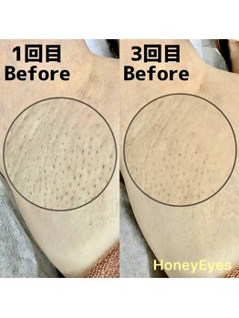 ハニーアイズ(Honey Eyes)/脇mix脱毛