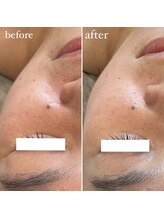 エクラ(eclat)/REVIハーブピーリング