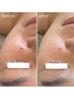 エクラ(eclat)/REVIハーブピーリング