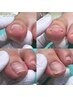巻き爪・陥入爪補正　1ヵ所　￥5500～