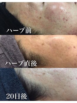 美肌工務店/赤み、肌荒れ改善!