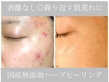 アリスビューティー(AliceBeauty)/繰り返す大人の肌荒れケアに