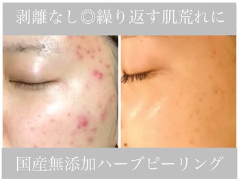 アリスビューティー(AliceBeauty)/繰り返す大人の肌荒れケアに