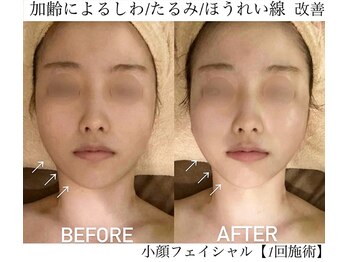 サロンハート(Salon Heart)/たるみ改善/しわほうれい線ケア