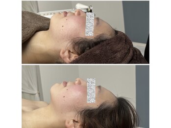 モア(moa)/フェイスライン/小顔/顎のライン