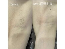 ハイリー 宇多津店/アニー アンド ジーノ ウタヅ(Hily/Annie&Gino utazu)の雰囲気（#脱毛#脇#before#after#3回照射）