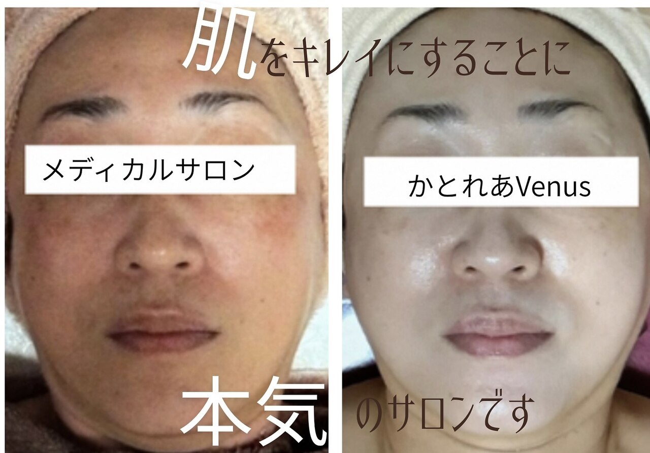 メディカルサロン かとれあ｜ホットペッパービューティー