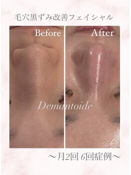 デマントイド(Demantoide&Co)/【毛穴黒ずみ】艶肌フェイシャル