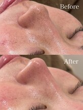 ミュー 岡崎店(mieux)/◇毛穴を綺麗にするにはmieux