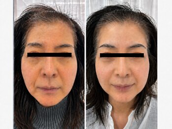 整顔院 学芸大学店/５０代　継続期間１年