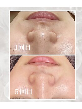 ホワイトラボ 川西(White labo)の写真/【韓国肌管理】憧れの韓国人のような"艶肌"を目指す＊肌の悩みに合わせた美容液を導入し徹底ケア！