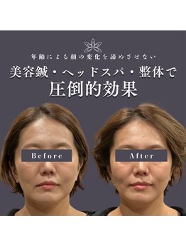 カロン(KALON)の写真/赤坂見附駅徒歩2分|結果重視!実力派サロンによる小顔美容鍼で”加工級小顔”に!丸顔むくみ・エラ張りにも◎