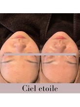 シエルエトワレ/La ChomB 鎮静保湿コース