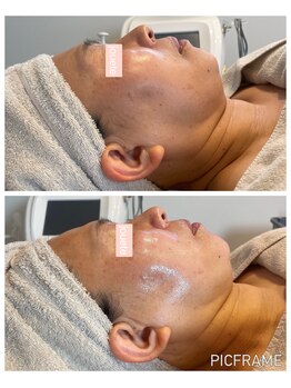 ジュエッテ(jouete)/大人気！小顔管理