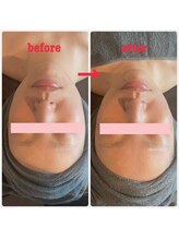 ダリア(Dahlia)/ハーブピーリング