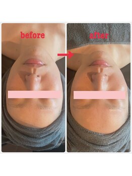 ダリア(Dahlia)/ハーブピーリング