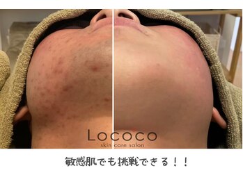 ロココ 山口店(Lococo)/一番人気はお顔の美肌脱毛