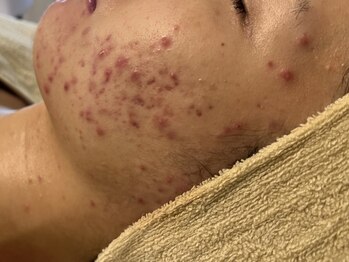 サロン ド エメ(salon de aimer)の写真/【最高峰肌質改善】繰り返すニキビのケア・予防に◎痛みが少なく、ダウンタイム無しで根本肌質改善！