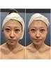 華奢デコルテ小顔＆毛穴・肌質改善90分　23,000→5,000円