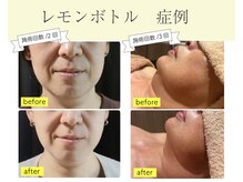 ラピスラズリの雰囲気（【レモンボトル】輪郭・たるみ引き上げ！最新フェイシャルケア）