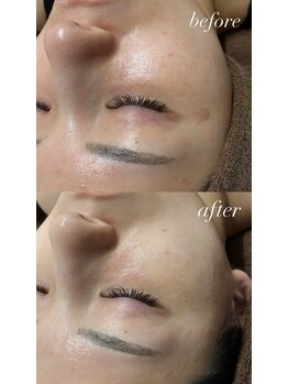 スマイルネイル(SMILE NAIL)/ハーブピーリング×毛穴洗浄