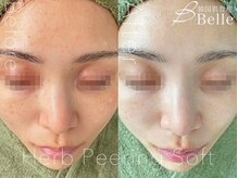 ベル 静岡(Belle)/静岡/ハーブピーリング/毛穴