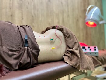 リボーン鍼灸整骨院(reborn鍼灸整骨院)/反り腰への鍼灸根本アプローチ