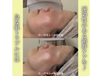 ハニエル(Haniel)/カーボキシー症例